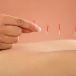 Close-up Of Person Receiving Acupuncture Treatment