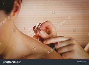 stock-photo-young-woman-getting-acupuncture-treatment-in-therapy-room